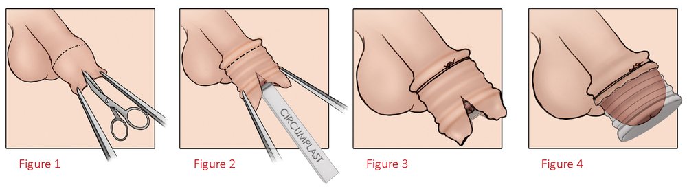 Circumcision procedure step by step