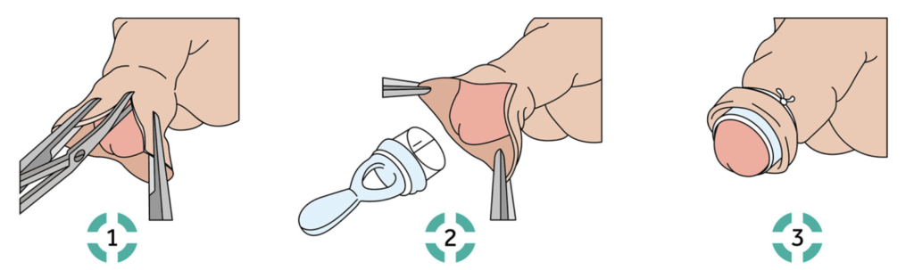 Circumcision procedure
